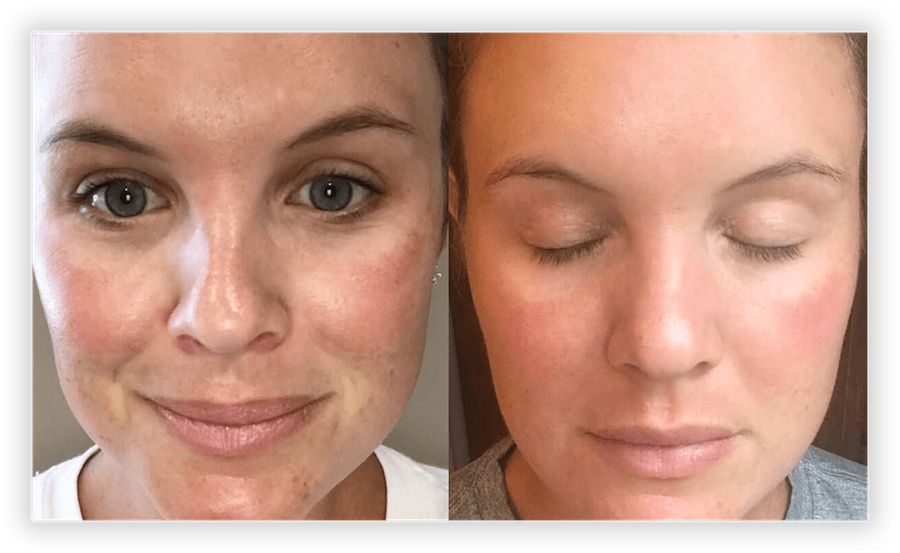 Non Surgical Facelift 2